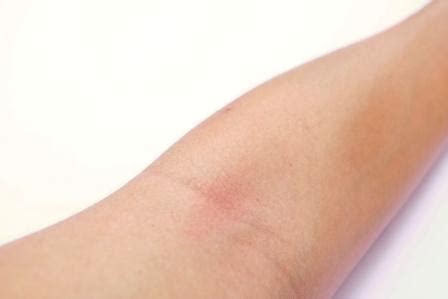 Intertrigo: Skin Fold Rashes: Causes, Ayurvedic Treatment, Remedies