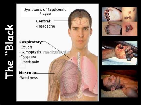 Yersinia pestis ~ Everything You Need to Know with Photos | Videos