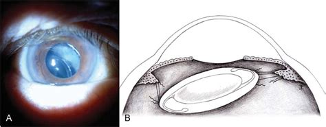 A. Posteroinferior PCIOL displacement, apparent on slitlamp... | Download Scientific Diagram