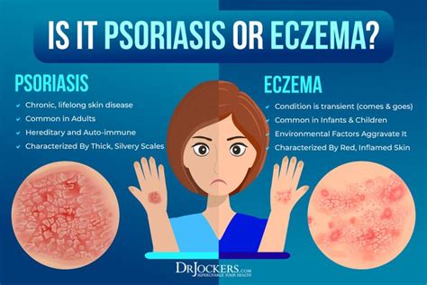 Eczema: Symptoms, Causes & Support Strategies - DrJockers.com Eczema Causes, Psoriasis Symptoms ...