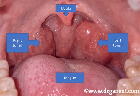 How to Get Rid of Tonsil Stones - Tonsil Stone Removal vs Tonsillectomy