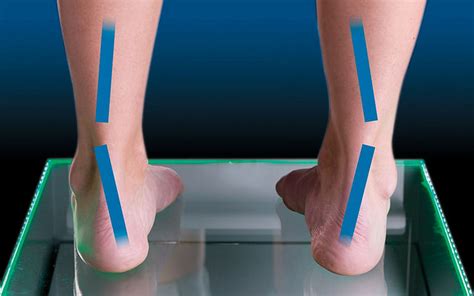 What to know about supination of the foot | Braceworks Custom Orthotics