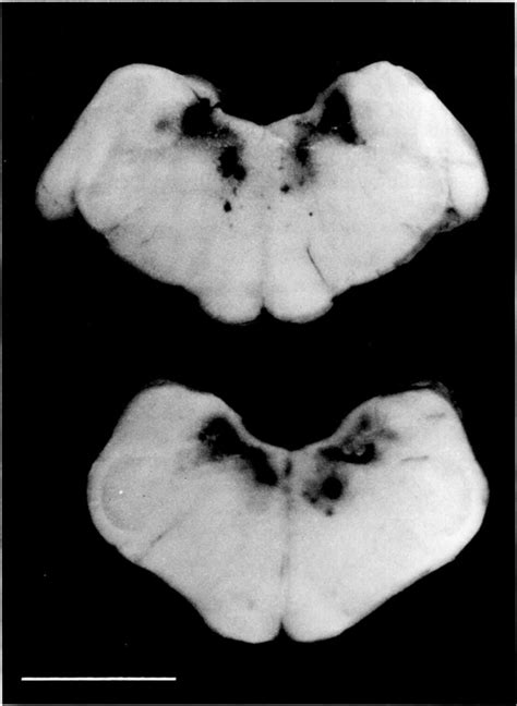 Bilaterally symmetrical hemorrhagic malacia in the lateral and medial... | Download Scientific ...