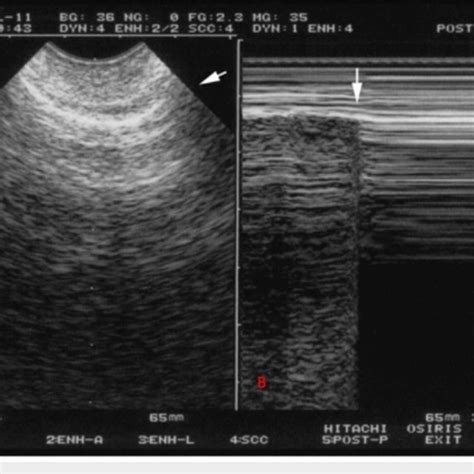 Ultrasound of the third intercostal space along the anterior axillary ...