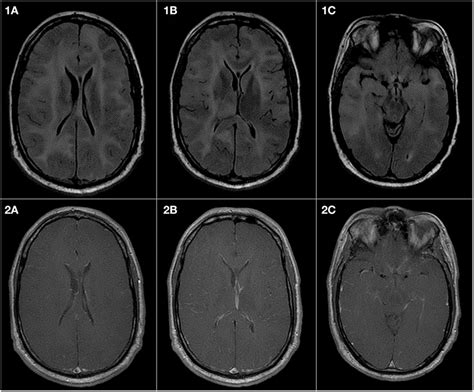 Frontiers | Gliomatosis Cerebri: Current Understanding and Controversies