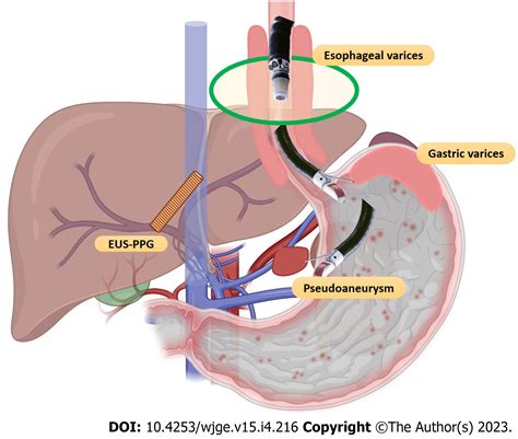 Endoscopic Ultrasound-guided Vascular Interventions: An, 47% OFF