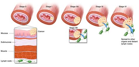 Esophageal Cancer From Smoking - adeliawelumi