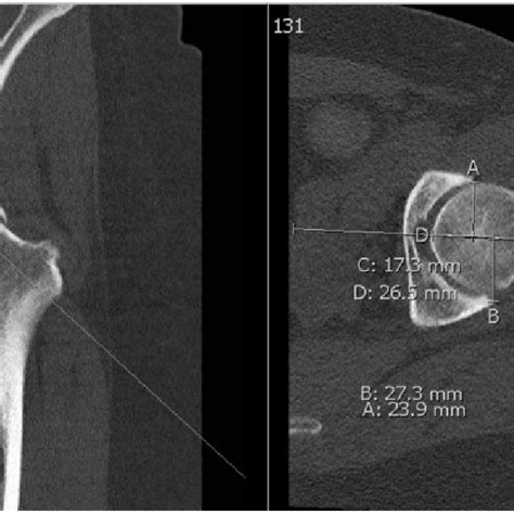 Patient with unilateral juvenile hypertrophy of the breast. (Upper raw)... | Download Scientific ...