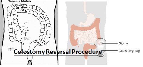 Ostomy Reversal Procedure: My Story - Patient's Lounge