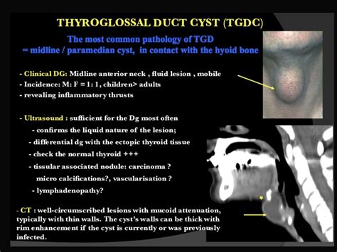 Thyroglossal Duct Cyst Ultrasound