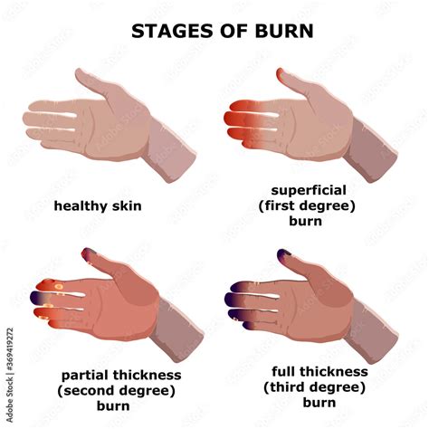 Medical vector illustration. Burn stages. Degree burns of skin. Stock ...