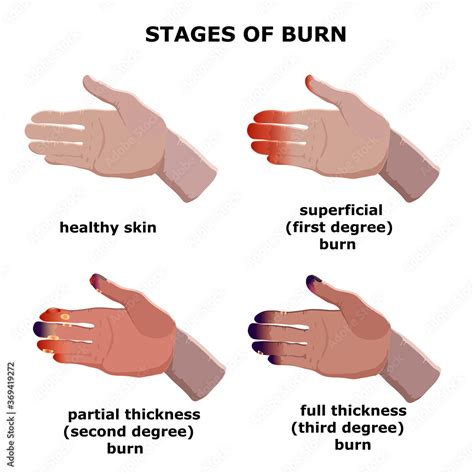 Medical vector illustration. Burn stages. Degree burns of skin. Stock Vector | Adobe Stock