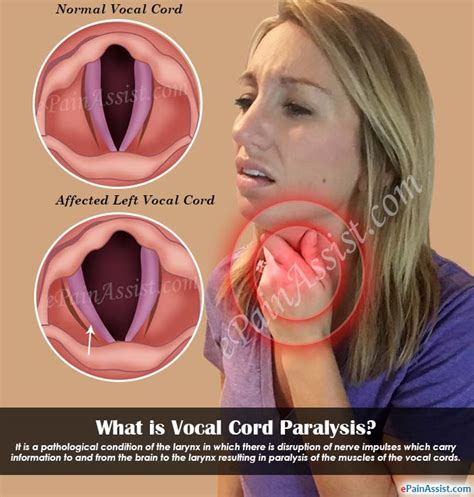 Vocal Cord Paralysis - Causes, Symptoms and Treatment ~ BIO Organic Life