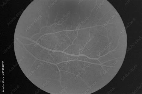 Fluorescein angiography of eye disease in the foreground Stock Photo | Adobe Stock