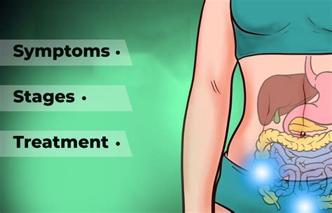 Colon Cancer - Symptoms, Stages and Treatment