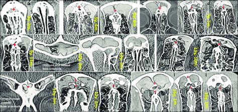 The Frontal Sinus & Septum's appearance at various ages of development ...