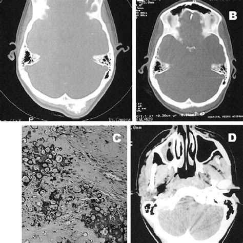 (PDF) Skull osteosarcoma: Illustrated review