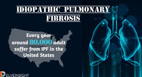 Idiopathic Pulmonary Fibrosis –Scarring For A Lifetime | DelveInsight