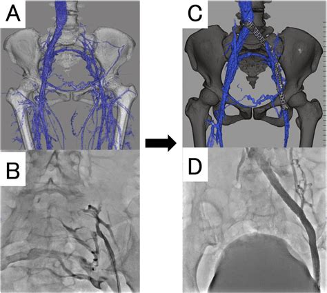 Postthrombotic iliac vein occlusion and the venous stenting A,... | Download Scientific Diagram