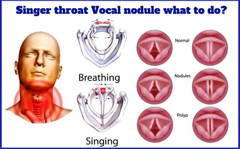 Vocal Nodules And Singers