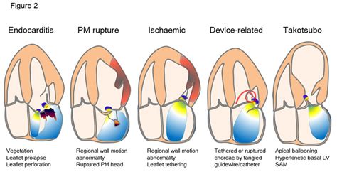 Mitral Regurgitation Grade