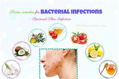 47 Home Remedies For Bacterial Infections On Skin, Blood, Mouth