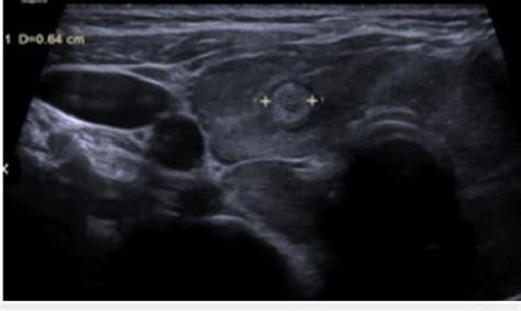 Ultrasound of thyroid. Heterogeneous thyroid echogenicity with ...