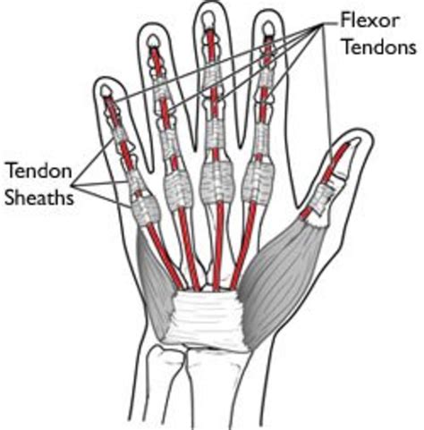 A Severed Flexor Tendon in the Pinky Finger | HealDove