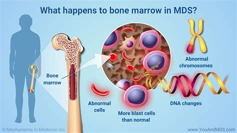 What happens to bone marrow in MDS? If you have MDS, your bone marrow will show DNA changes ...