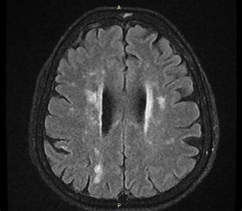 white matter disease mri Mri lesions diffuse axial - Diseases Club center