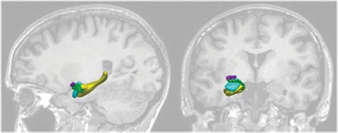 Three-Dimensional relationship of the right piriform cortex on the... | Download Scientific Diagram