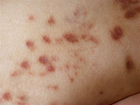 How Does Diabetic Skin Rash Look Like?