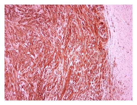 Poorly differentiated adenocarcinoma on gastroesophageal junction (a ...