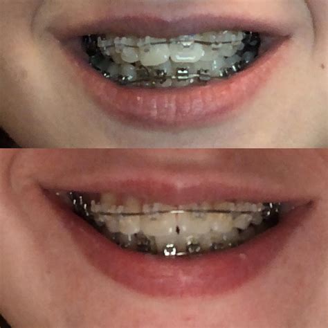 Adult braces at 20 years old, about 3 months in! Problems are severe overcrowding, overjet, and ...