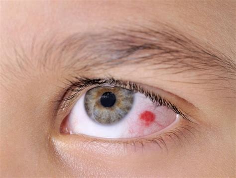 What Causes a Popped Blood Vessel in the Eye? (with pictures)