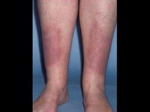 Graves Disease - Symptoms, Causes, Diet, Diagnosis, Treatment