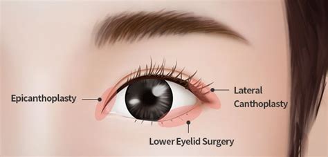 Epicanthoplasty - The Clifford Clinic