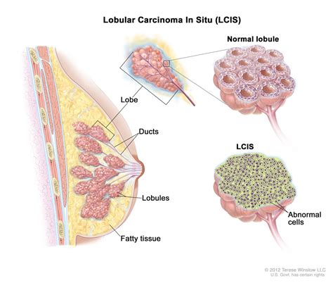 CÁNCER DE MAMA: Anatomía patológica del cáncer de mama