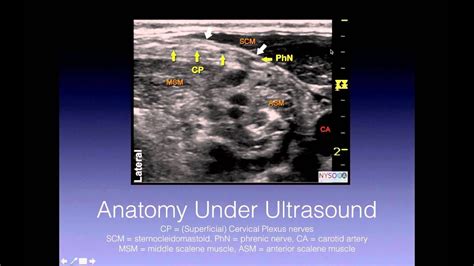 Tutorial Superficial Cervical Plexus Block YouTube - Dermatomes Chart ...
