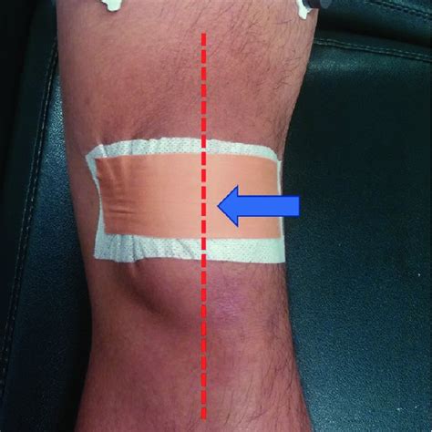 The "J"-sign, known as the lateral patellar tracking on anterior view... | Download Scientific ...