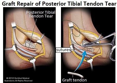 Posterior Tibial Tendonitis - Foot Pain Explored