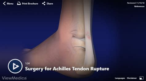 Video: Surgery for Achilles Tendon Rupture - Hughston Clinic