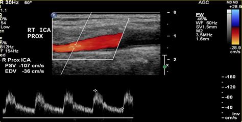 Carotid Artery: Carotid Artery Us