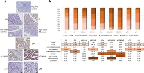 OLFM4, KNG1 and Sec24C identified by proteomics and immunohistochemistry as potential markers of ...