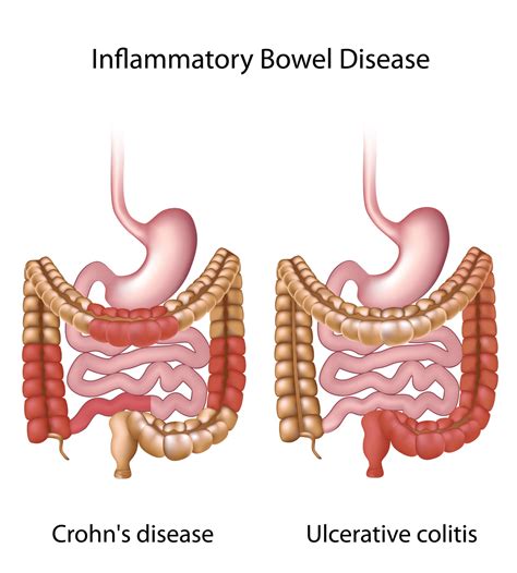 Crohn’s Disease | Symptoms and Treatment | Private Gastro London