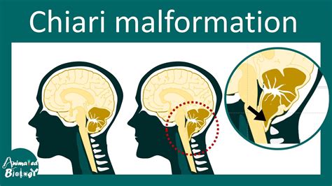 Chiari Malformation and Treatment | Type I and II Chiari malformation - YouTube