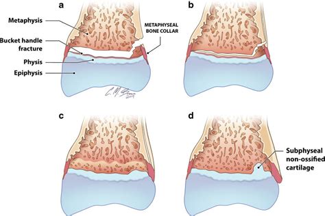 Illustrations of hypothesized phases of classic metaphyseal lesion... | Download Scientific Diagram