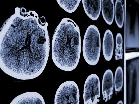 Does schizophrenia show on a brain scan?