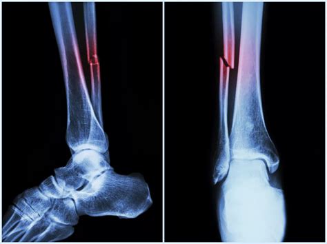 Non-Surgical vs. Surgical Treatment of Fractures | Orthopaedic Specialists of Austin