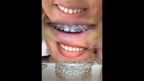 Post Brace update, clear retainers before and after pics - YouTube